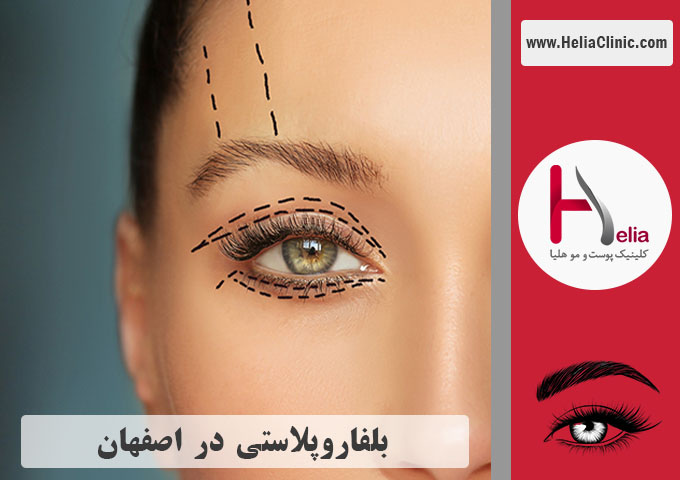 عمل جراجی پلک در اصفهان