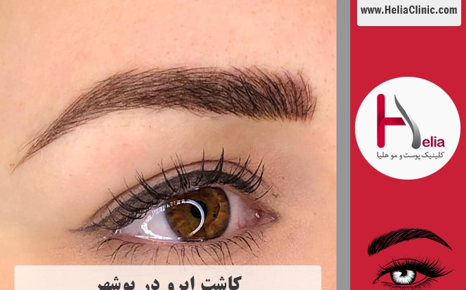 کاشت ابروی طبیعی در بوشهر