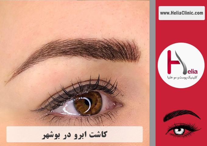 کاشت ابروی طبیعی در بوشهر