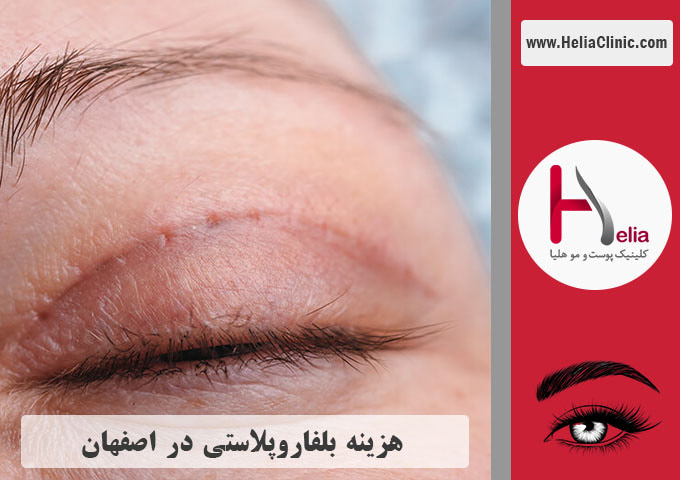 قیمت جراحی پلک در اصفهان