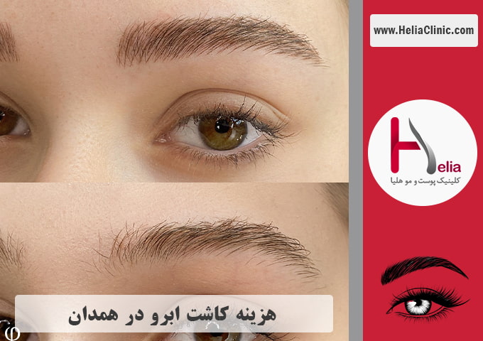 قیمت کاشت ابروی طبیعی در شهر همدان