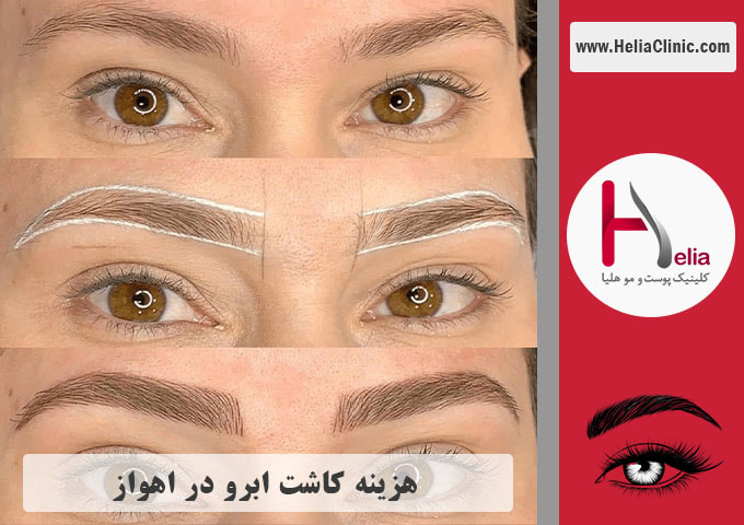 قیمت کاشت ابروی طبیعی در اهواز