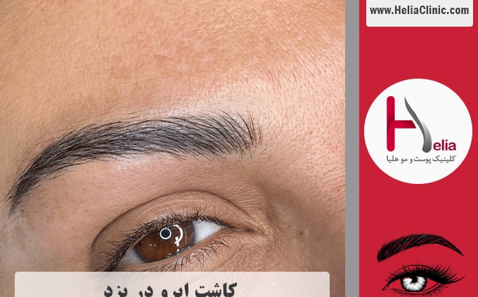 کاشت ابروی طبیعی در یزد
