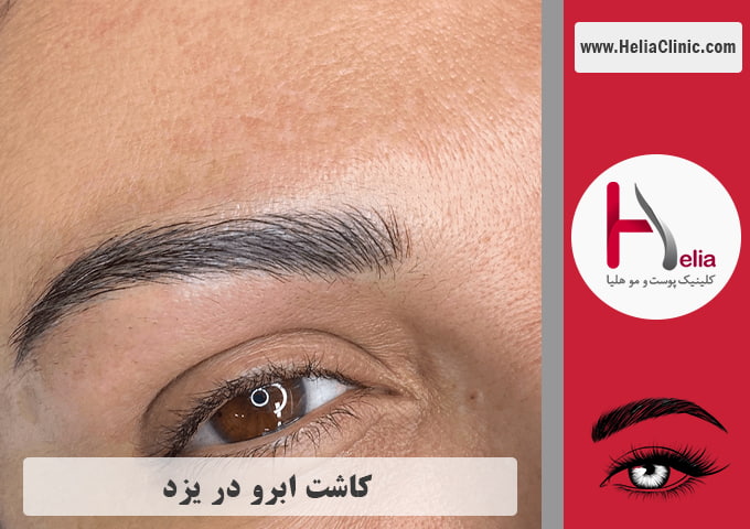 کاشت ابروی طبیعی در یزد