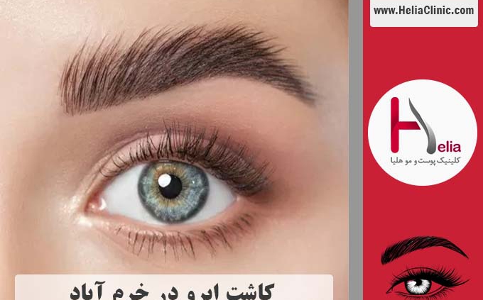 کاشت ابرو در خرم آباد - استان لرستان