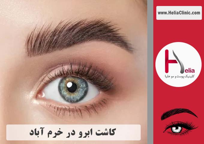 کاشت ابرو در خرم آباد - استان لرستان
