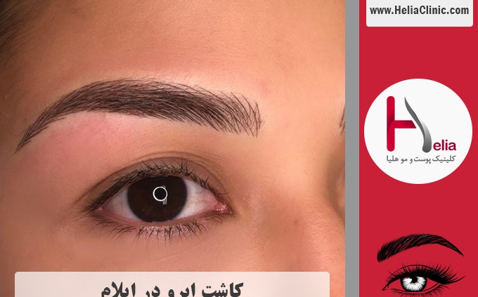 کاشت ابرو در ایلام