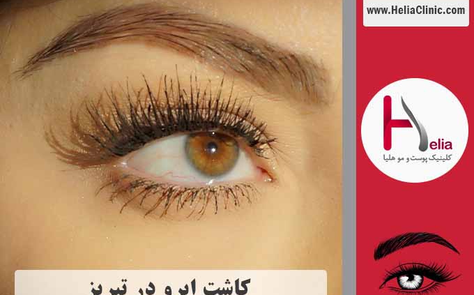 کاشت ابرو در شهر تبریز