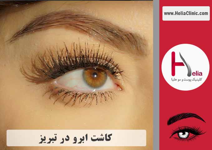 کاشت ابرو در شهر تبریز