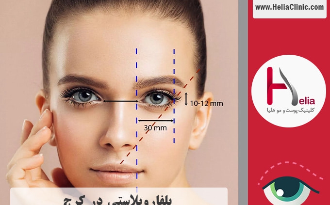 عمل جراحی پلک در کرج