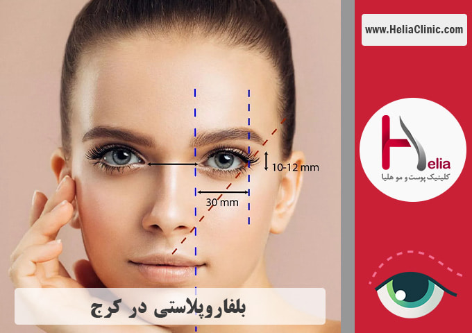 عمل جراحی پلک در کرج