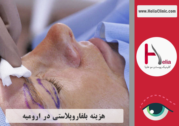 قیمت عمل جراحی پلک در ارومیه