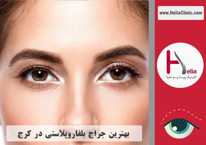 بهترین جراح پلک در کرج