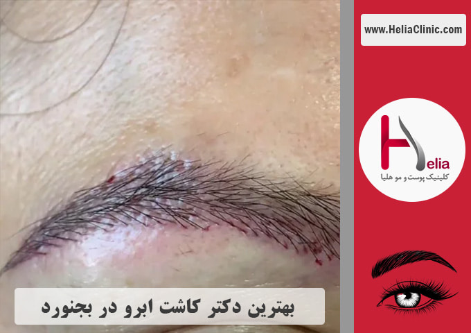 بهترین دکتر و مرکز کاشت ابروی طبیعی در بجنورد