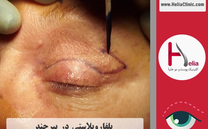عمل بلفاروپلاستی در بیرجند