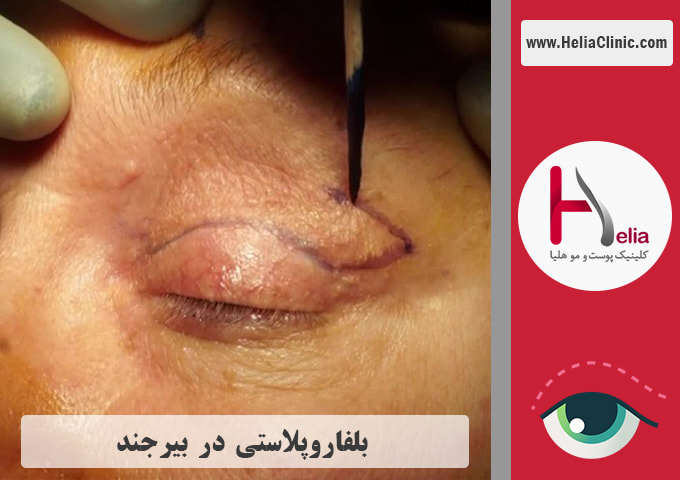 عمل بلفاروپلاستی در بیرجند