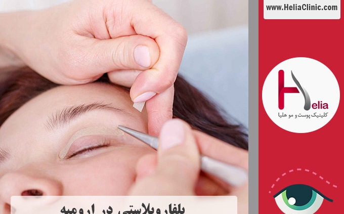 عمل بلفاروپلاستی در ارومیه