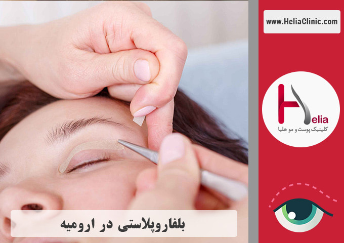 عمل بلفاروپلاستی در ارومیه