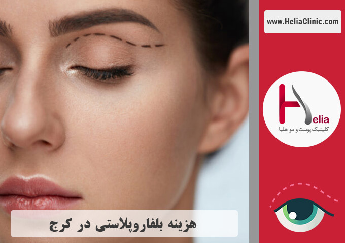 قیمت عمل بلفاروپلاستی در کرج