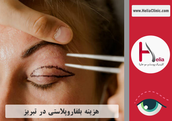 قیمت جراحی پلک در تبریز