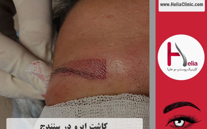 کاشت ابروی طبیعی در سنندج