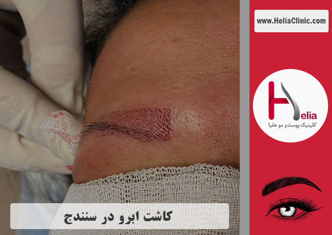 کاشت ابروی طبیعی در سنندج