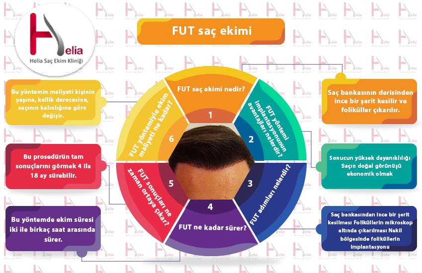 FUT Saç Ekimi İnfografik