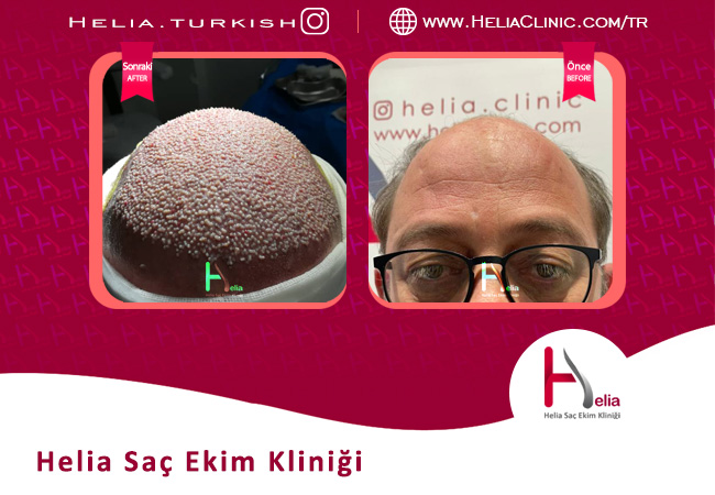 FUT yöntemi ile saç ekimi maliyeti