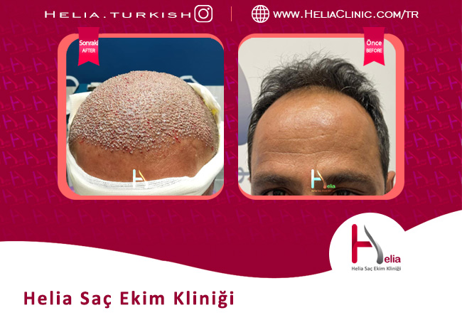 Fut saç ekimi alıcı bölgede nasıl yapılır?