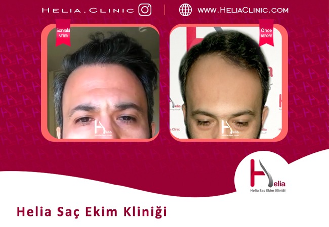 Helia cilt ve saç kliniği Türkiye şubesinde saç ekimi fiyatı (2022)
