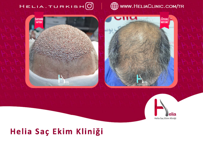 İstanbul Helia Clinic'te dhi saç ekimi