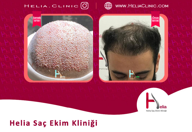 2022 yılında İstanbul'un en iyi saç ekim kliniği ve doktoru