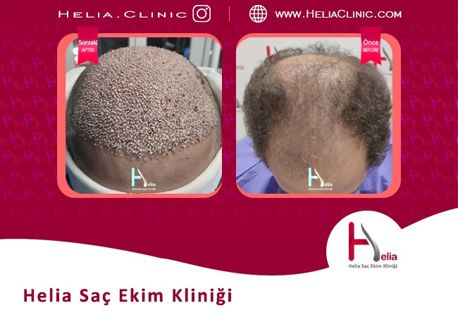 Helia-Kliniği-ameliyatsız-saç-ekimi-öncesi-ve-sonrası-fotoğraf