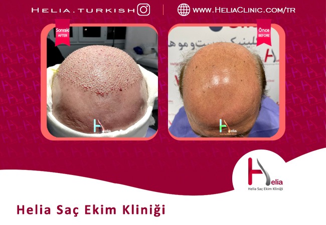 Helia clinic neden İstanbul'un en iyi saç ekim merkezi?