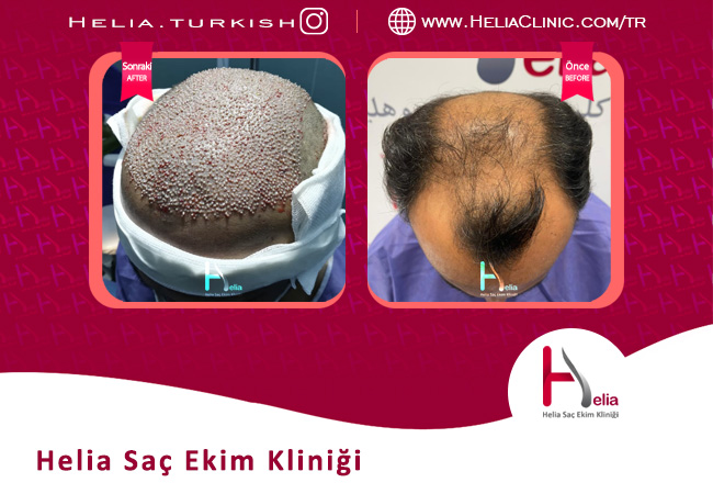 İstanbul'daki Helia Clinic'teki en iyi saç ekim doktorunun öncesi ve sonrası fotoğrafları