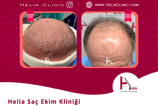 Türkiye'deki en iyi saç ekim merkezini seçme kriterleri