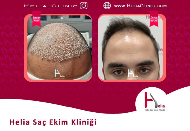 Türkiye'deki son saç ekim yönteminin öncesi ve sonrası fotoğrafları