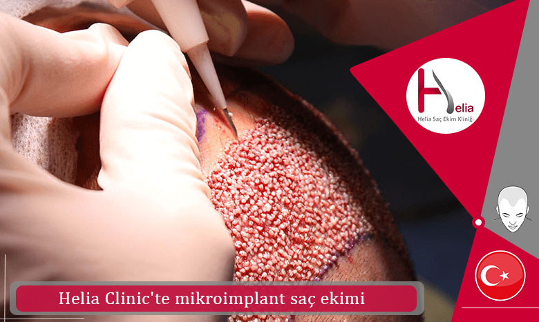 Helia Clinic'te mikroimplant saç ekimi