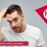 Saç ekiminin nihai sonuçları