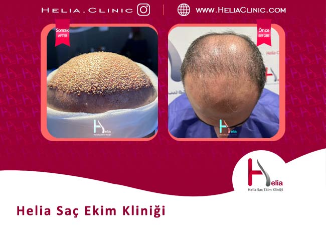 Türkiye'de en iyi saç ekim yöntemi   Helia Kliniği