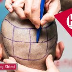 Neograft Saç Ekimi