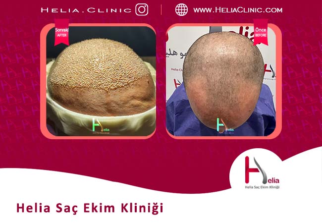 Helia cilt ve saç kliniğinde en iyi saç restorasyon yöntemini tanıtmak