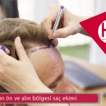 Başın ön ve alın bölgesi saç ekimi