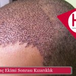 Saç Ekimi Sonrası Kızarıklık