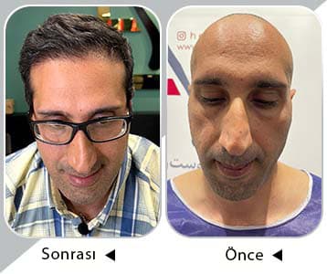 Dr. Horasani tarafından Türkiye'de saç ekimi