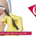 پیوند ابرو SUT، بررسی نتایج و ماندگاری