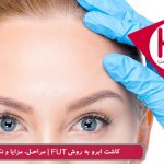 نکات مهم پیوند ابرو به روش FUT