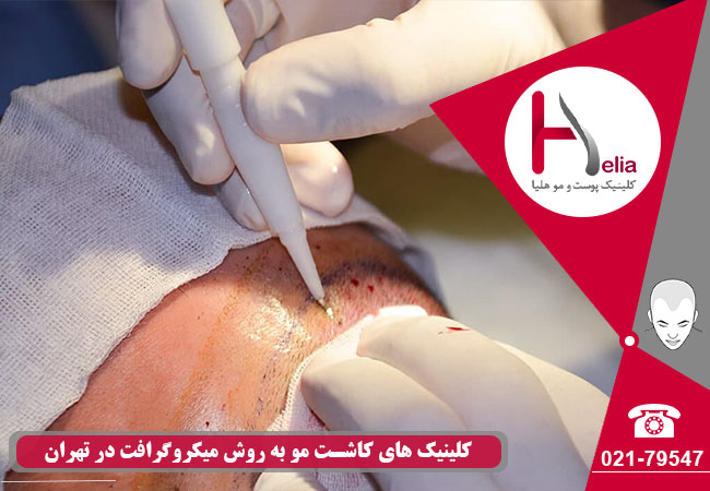 مراکز تخصصی پیوند مو روش میکروگرافت در تهران