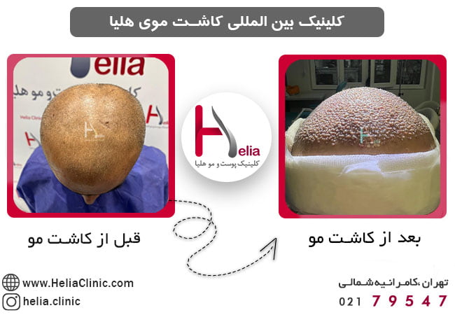 قبل و بعد از کاشت مو از بالای سر