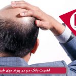 اهمیت بانک مو در پیوند موی طبیعی